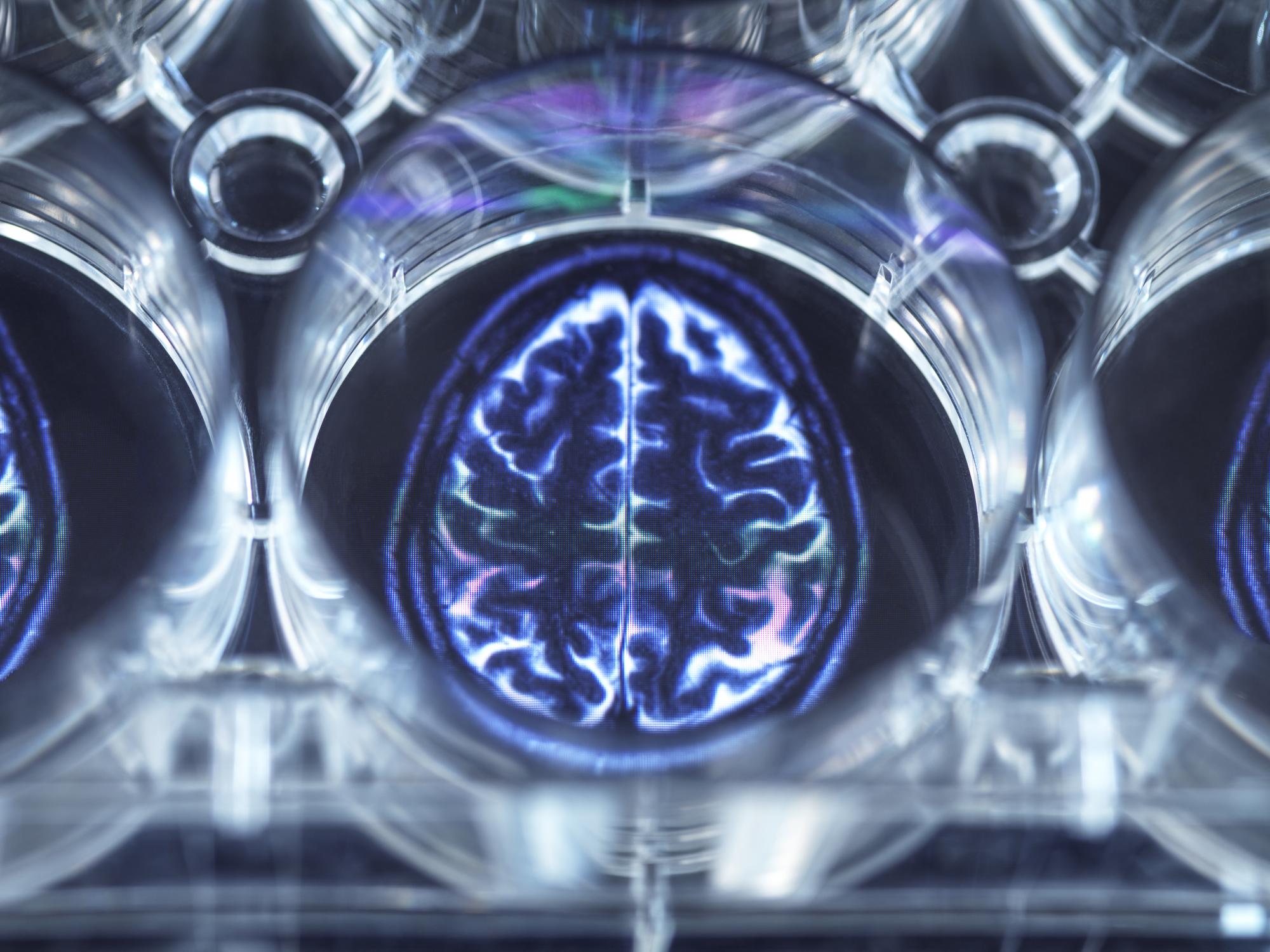 CBD e convulsões: como a cannabis medicinal está transformando o tratamento da epilepsia